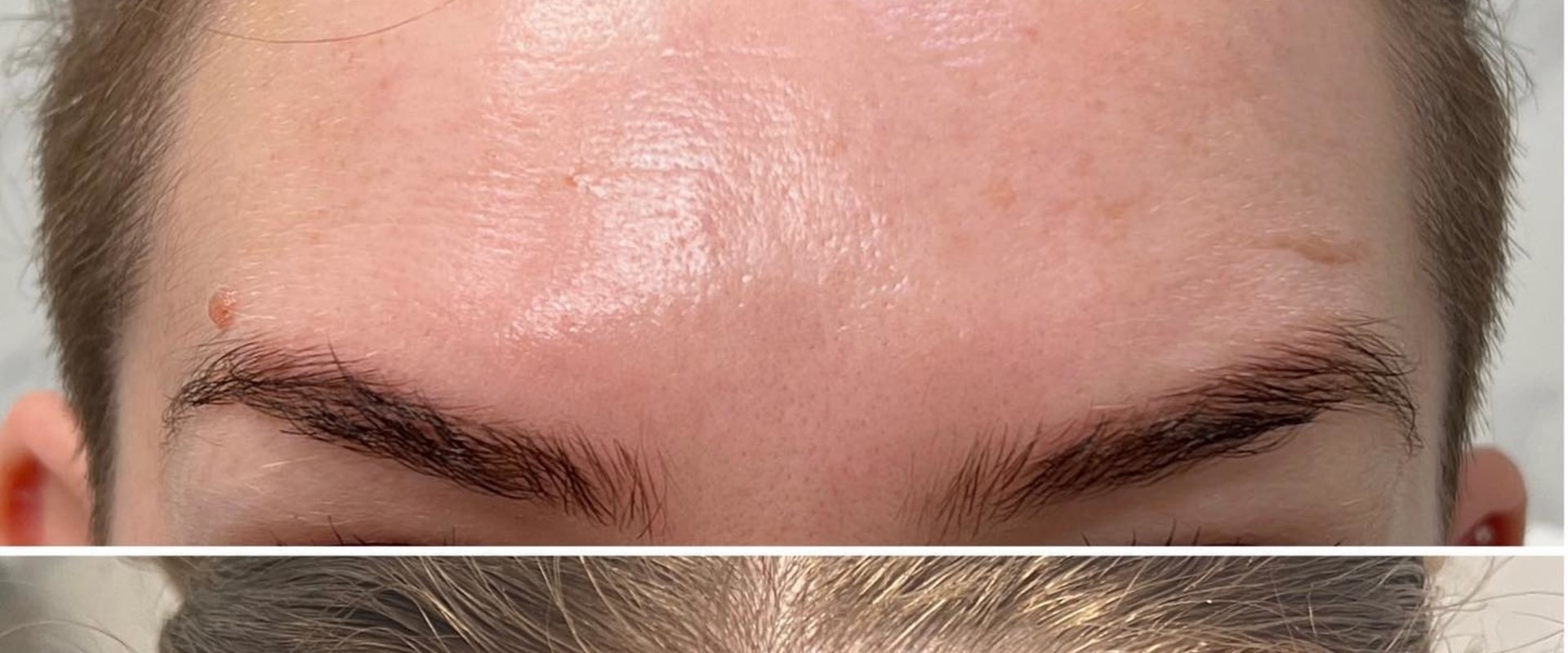 The Truth About Botox: What You Need to Know