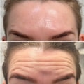 The Truth About Botox: What You Need to Know