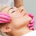 The Revolutionary PDO Thread Lift: What You Need to Know
