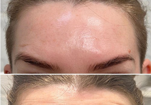 The Truth About Botox: What You Need to Know